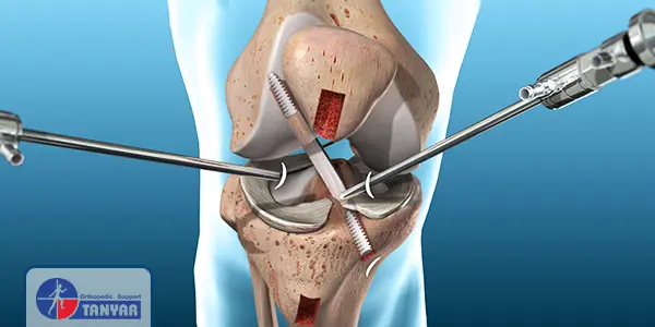 جراحی رباط صلیبی