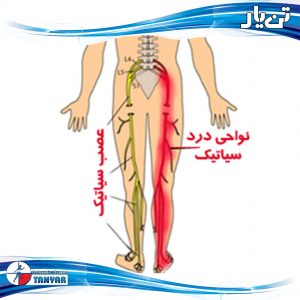 sciatica