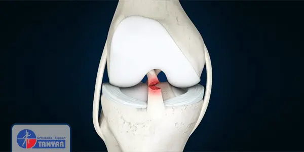 پارگی رباط صلیبی