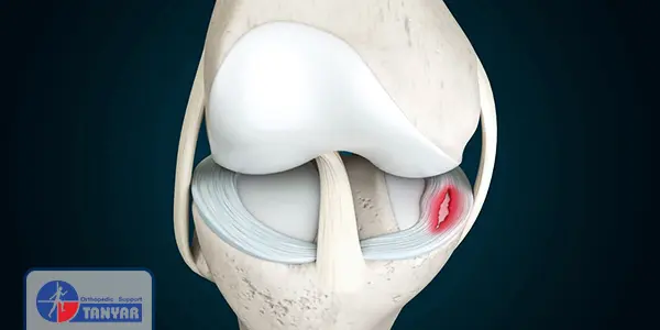 پارگی رباط مینیسک