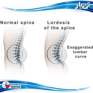 large_spine_lordosis