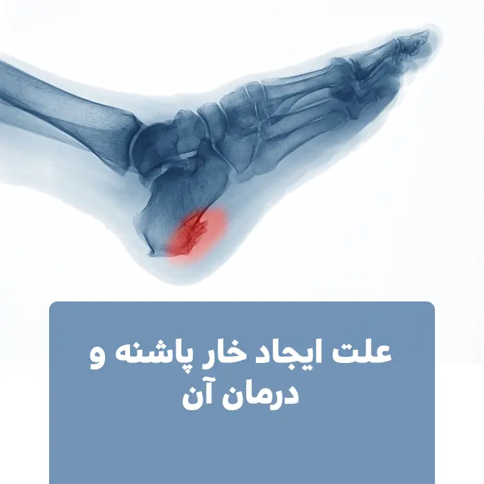علت ایجاد خار پاشنه